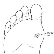 Plantar Warts